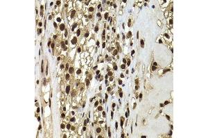 Immunohistochemistry of paraffin-embedded human kidney cancer using ACTL6B antibody. (Actin-Like 6B antibody  (AA 1-280))