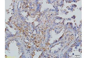 Formalin-fixed and paraffin embedded human endometrial cancer labeled with Anti-CCL19/MIP-3 beta Polyclonal Antibody, Unconjugated (ABIN740505) followed by conjugation to the secondary antibody