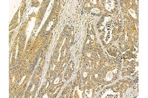 ABIN7094411 and ABIN7098458 at 1/100 staining Human colorectal cancer by IHC-P. (ODF2L antibody  (N-Term))