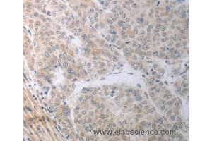 Immunohistochemistry of Human liver cancer using RBMS3 Polyclonal Antibody at dilution of 1:70