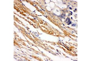Anti- C-Kit Picoband antibody, IHC(P) IHC(P): Human Intestinal Cancer Tissue