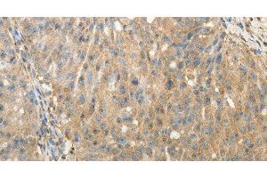 Immunohistochemistry of paraffin-embedded Human ovarian cancer using SULT1E1 Polyclonal Antibody at dilution of 1:30 (SULT1E1 antibody)
