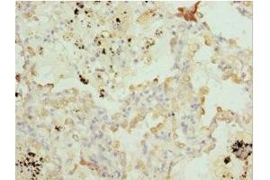 Immunohistochemistry of paraffin-embedded human lung cancer using ABIN7165145 at dilution of 1:100