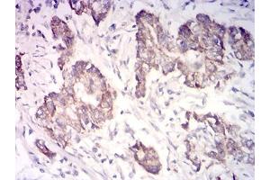 Immunohistochemical analysis of paraffin-embedded stomach cancer tissues using CYCS mouse mAb with DAB staining. (Cytochrome C antibody  (AA 1-105))