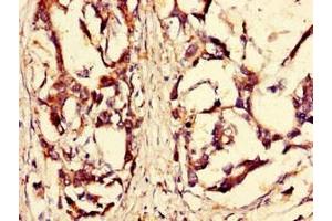 Immunohistochemistry of paraffin-embedded human gastric cancer using ABIN7168184 at dilution of 1:100 (MSK2 antibody  (AA 237-393))