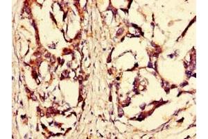 Immunohistochemistry of paraffin-embedded human gastric cancer using ABIN7168184 at dilution of 1:100 (MSK2 antibody  (AA 237-393))
