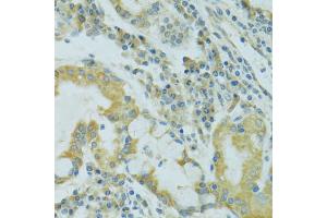 Immunohistochemistry of paraffin-embedded human lung cancer using TJP2 antibody. (TJP2 antibody)