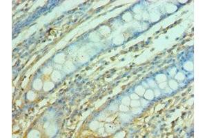 Immunohistochemistry of paraffin-embedded human colon tissue using ABIN7153122 at dilution of 1:100 (FOSL1 antibody  (AA 1-100))