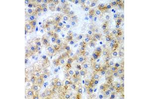 Immunohistochemistry of paraffin-embedded human liver cancer using LY86 antibody at dilution of 1:200 (40x lens).