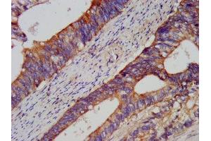 IHC image of ABIN7174324 diluted at 1:200 and staining in paraffin-embedded human colon cancer performed on a Leica BondTM system.