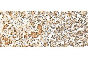 Immunohistochemistry of paraffin-embedded Human prost at e cancer tissue using HLA-DRB1 Polyclonal Antibody at dilution of 1:75(x200) (HLA-DRB1 antibody)