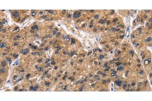 Immunohistochemistry of paraffin-embedded Human liver cancer tissue using ABI3BP Polyclonal Antibody at dilution 1:50 (ABI3BP antibody)