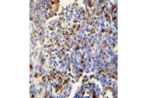 Immunohistochemistry analysis in formalin fixed andparaffin embedded human lung carcinoma reactedwith FOSL2 Antibody (Center) Cat. (FOSL2 antibody  (Middle Region))