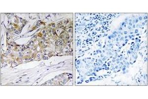 Immunohistochemistry analysis of paraffin-embedded human breast carcinoma tissue, using DHRS11 Antibody. (DHRS11 antibody  (AA 111-160))