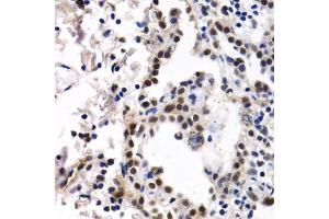 Immunohistochemistry of paraffin-embedded human lung cancer using ID3 antibody. (ID3 antibody)