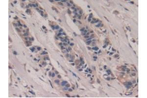 IHC-P analysis of Human Breast Cancer Tissue, with DAB staining. (Poliovirus Receptor antibody  (AA 56-309))