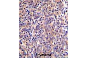 THEMIS Antibody (C-term) immunohistochemistry analysis in formalin fixed and paraffin embedded human thymoma followed by peroxidase conjugation of the secondary antibody and DAB staining. (THEMIS antibody  (C-Term))