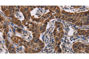 Immunohistochemistry of paraffin-embedded Human lung cancer tissue using GRK3 Polyclonal Antibody at dilution 1:50 (ADRBK2 antibody)