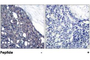 Immunohistochemical analysis of paraffin-embedded human breast carcinoma tissue using NFKBIA polyclonal antibody . (NFKBIA antibody)