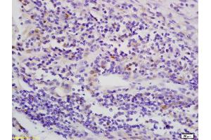 Formalin-fixed and paraffin embedded human esophagus carcinoma labeled with Anti-phospho-LKB1 (Thr363) Polyclonal Antibody, Unconjugated (ABIN687877) at 1:200 followed by conjugation to the secondary antibody and DAB staining (LKB1 antibody  (pThr363))