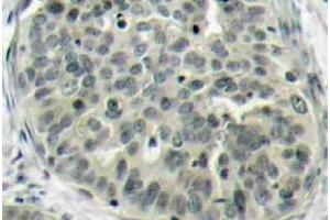 Immunohistochemistry (IHC) analyzes of p-Catenin-beta antibody in paraffin-embedded human breast carcinoma tissue. (CTNNB1 antibody  (pSer37))