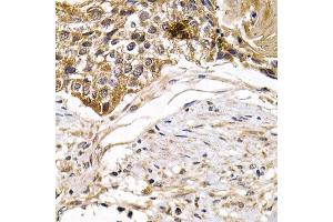 Immunohistochemistry of paraffin-embedded human mammary cancer using ARRB2 antibody. (Arrestin 3 antibody)