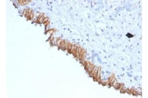 IHC testing of FFPE human bladder carcinoma with MAML2 antibody (clone MAML2/1302). (MAML2 antibody)