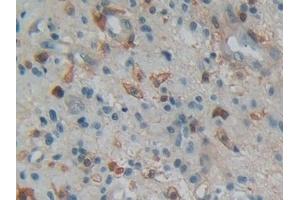 Detection of GSN in Human Glioma Tissue using Polyclonal Antibody to Gelsolin (GSN) (Gelsolin antibody  (AA 577-771))
