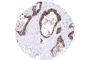 Colon Colorectal adenocarcinoma with strong CDH17 immunostaining of all tumor cells CDH17 immunohistochemistry (LI Cadherin antibody  (AA 242-418))
