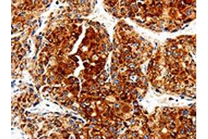 The image is immunohistochemistry of paraffin-embedded Human liver cancer tissue using ABIN7129012(COX19 Antibody) at dilution 1/50. (COX19 antibody)