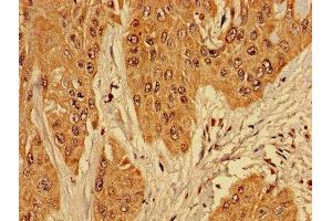 Immunohistochemistry of paraffin-embedded human cervical cancer using ABIN7142728 at dilution of 1:100 (RPL10L antibody  (AA 1-214))