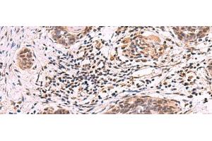 Immunohistochemistry of paraffin-embedded Human esophagus cancer tissue using ARIH2 Polyclonal Antibody at dilution of 1:80(x200)