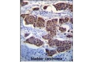 LM3 Antibody (C-term) (ABIN655704 and ABIN2845155) immunohistochemistry analysis in formalin fixed and raffin embedded human bladder carcinoma followed by peroxidase conjugation of the secondary antibody and DAB staining. (PALM3 antibody  (C-Term))