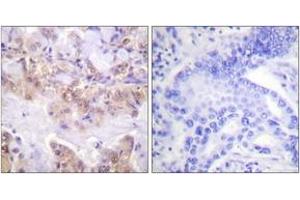 Immunohistochemistry analysis of paraffin-embedded human lung carcinoma, using C-RAF (Phospho-Ser621) Antibody.