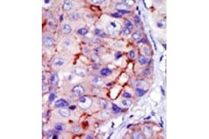 Formalin-fixed and paraffin-embedded human cancer tissue (hepatocarcinoma) reacted with the primary antibody, which was peroxidase-conjugated to the secondary antibody, followed by DAB staining. (CAMK1D antibody  (C-Term))