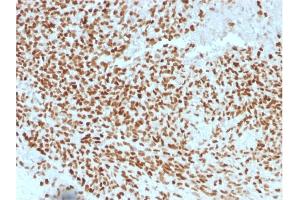 Formalin-fixed, paraffin-embedded human Ewing's Sarcoma stained with NKX2. (Nkx2-2 antibody  (AA 1-119))