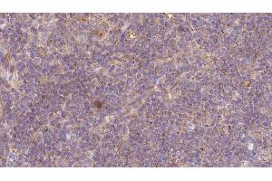 ABIN6273177 at 1/100 staining Human lymph cancer tissue by IHC-P. (Tropomodulin 1 antibody  (N-Term))