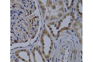 Immunohistochemistry of paraffin-embedded Human kidney cancer using WDR5 Polyclonal Antibody at dilution of 1:200 (40x lens). (WDR5 antibody)