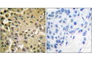 Immunohistochemistry analysis of paraffin-embedded human breast carcinoma, using Smad3 (Phospho-Ser425) Antibody.