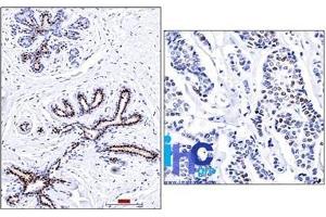 Formalin-fixed, paraffin-embedded normal human breast (left) and invasive ductal carcinoma (right) stained with progesterone receptor Ab (PR501). (Progesterone Receptor antibody)