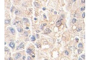Immunohistochemical staining of formalin-fixed paraffin-embedded human liver tissue showing membrane staining with AKR1A1 polyclonal antibody  at 1 : 100 dilution. (AKR1A1 antibody  (AA 132-310))
