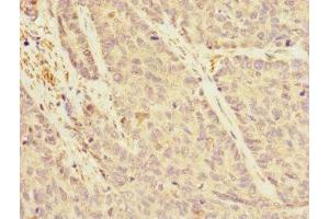 Immunohistochemistry of paraffin-embedded human ovarian cancer using ABIN7167162 at dilution of 1:100