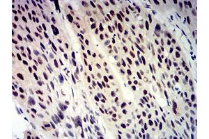 Immunohistochemical analysis of paraffin-embedded rectum cancer tissues using BTRC mouse mAb with DAB staining. (BTRC antibody  (AA 24-151))