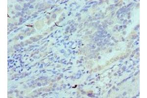 Immunohistochemistry of paraffin-embedded human lung cancer using ABIN7147246 at dilution of 1:100 (CADM1 antibody  (AA 45-344))