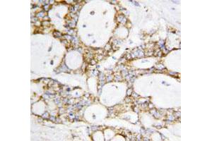 Immunohistochemical staining of paraffin embedded human breast cancer tissue section with DLD polyclonal antibody . (DLD antibody  (C-Term))
