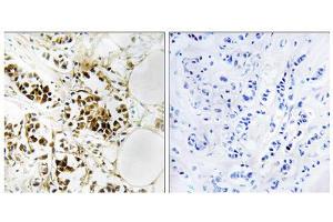 Immunohistochemistry analysis of paraffin-embedded human breast carcinoma tissue, using RGS5 antibody. (RGS5 antibody  (Internal Region))
