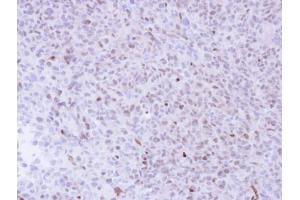 IHC-P Image Immunohistochemical analysis of paraffin-embedded H1299 Xenograft , using NGFRAP1, antibody at 1:100 dilution. (Nerve Growth Factor Receptor (TNFRSF16) Associated Protein 1 (NGFRAP1) (Center) antibody)