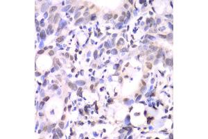 Immunohistochemistry of paraffin-embedded human gastric cancer using HAT1 antibody at dilution of 1:100 (x40 lens). (HAT1 antibody)