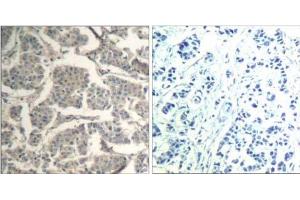 Immunohistochemical analysis of paraffin-embedded human breast carcinoma tissue using cofilin1/cofilin2 (Ab -88) Antibody (E021507). (Cofilin1/2 (CFL1/2) antibody)