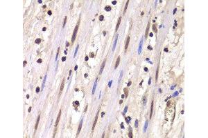 Immunohistochemistry of paraffin-embedded Human mammary cancer using LSM4 Polyclonal Antibody at dilution of 1:100 (40x lens). (LSM4 antibody)